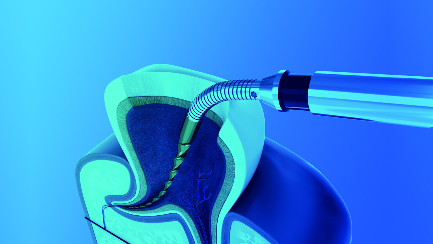 Cross-section render of the Spring Endo File flexing inside a curved root canal